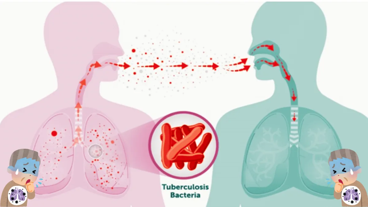 WHO Global Tuberculosis Report 2025: India Records 21% Fall in TB Incidence but Misses 2025 Elimination Target